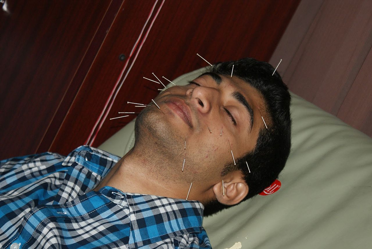 Facial Acupuncture