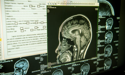 Algernon Pharmaceuticals is investigatng new stroke treatments using DMT
