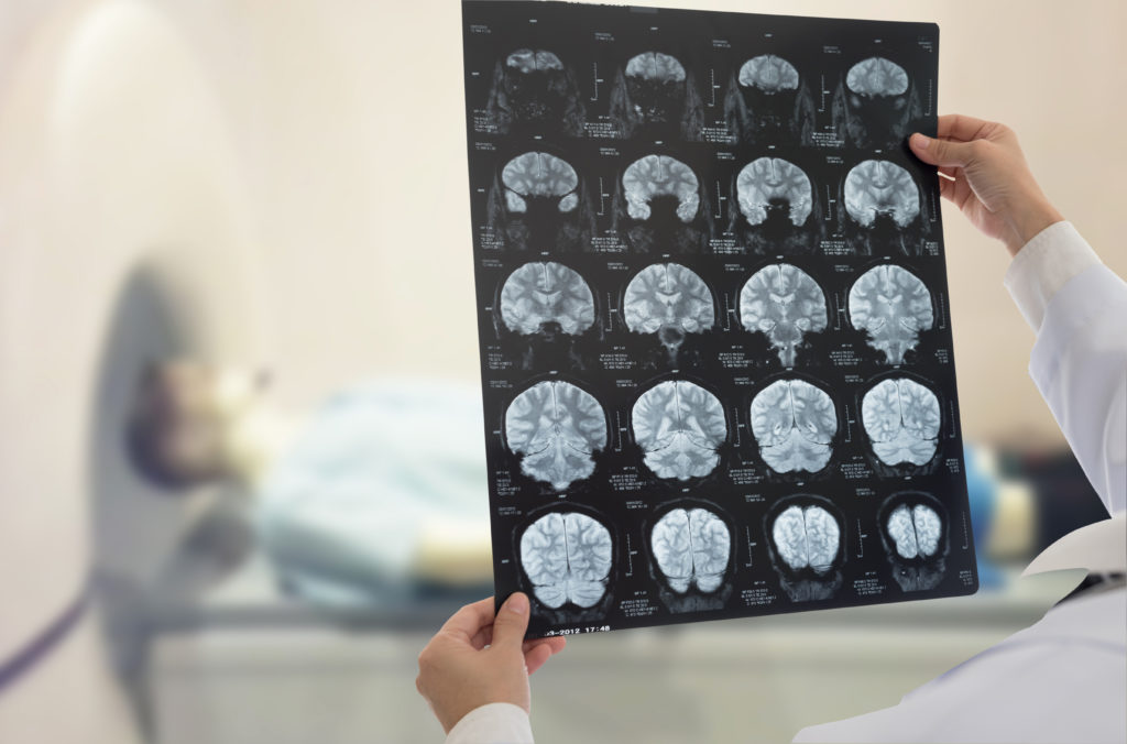 MRIs are required to determine the nature of a stroke, which can prevent useful treamtment, but not the DMT Algernon Pharmaceuticals is investigating