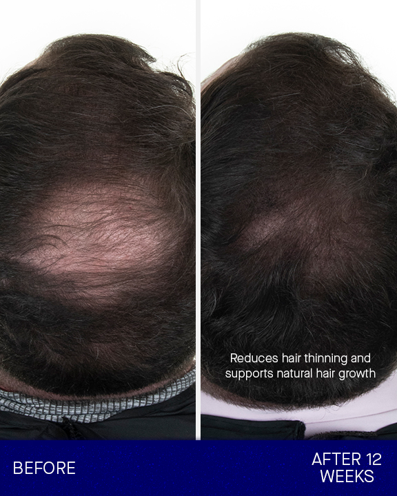 Clinical trial results of augustinus bader hair loss supplements