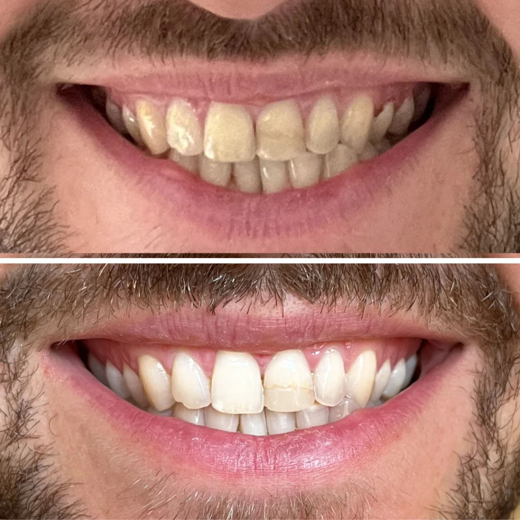 MySweetSmile teeth whitening before and after