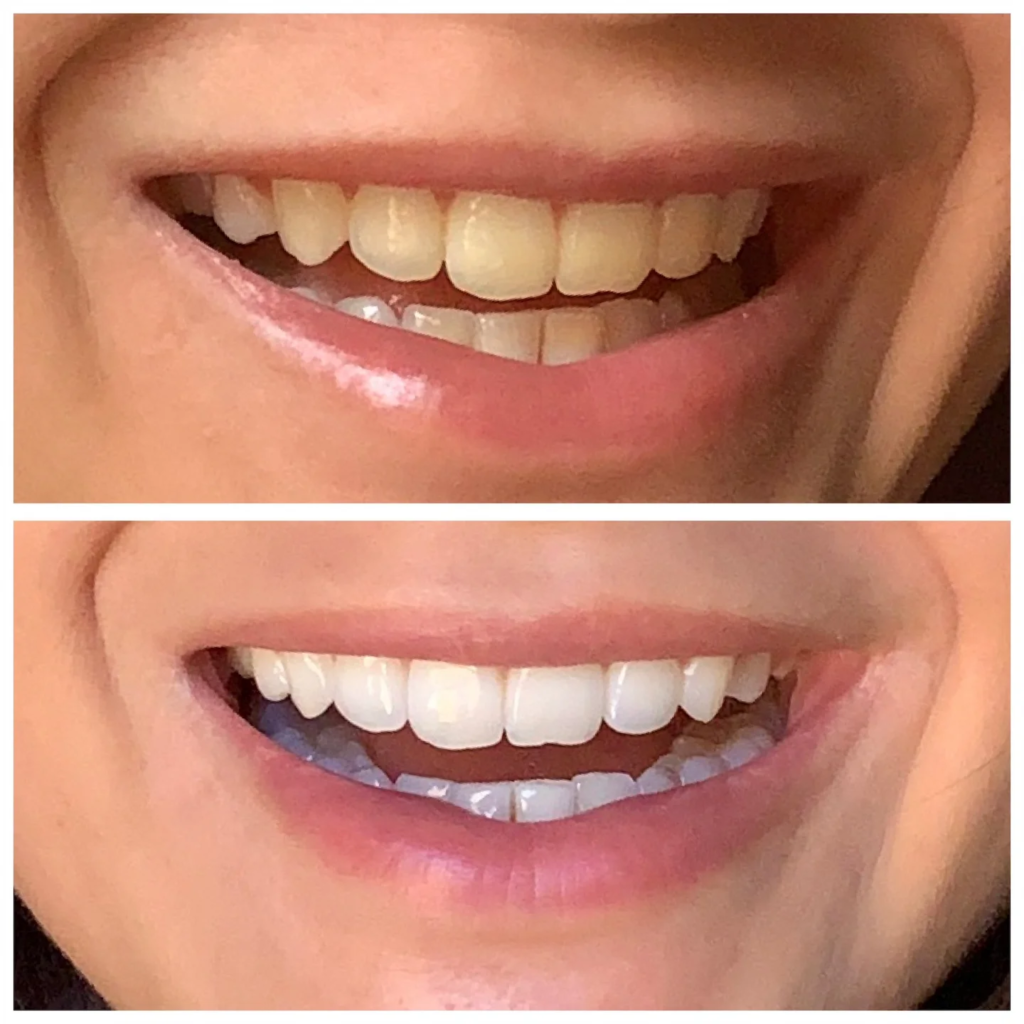 MySweetSmile teeth whitening before and after
