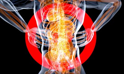 IgA nephropathy