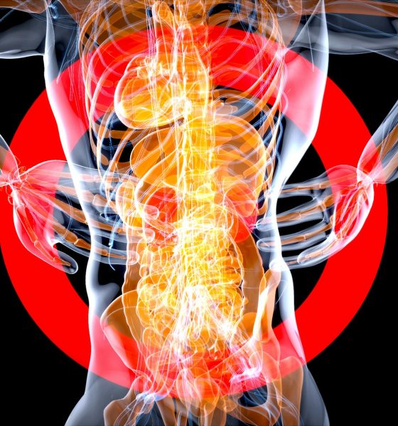 IgA nephropathy