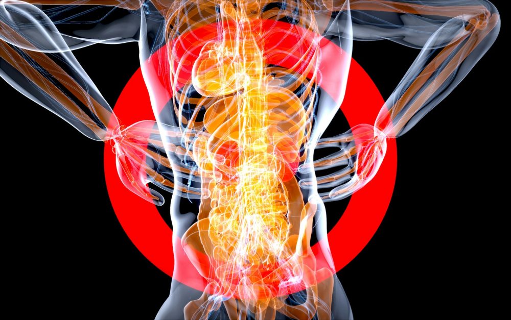 IgA nephropathy